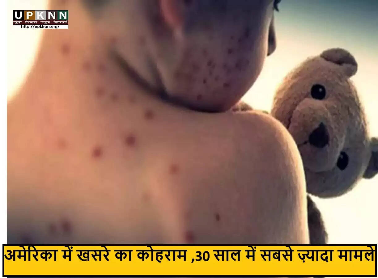 अमेरिका में खसरे के मामलों में अभूतपूर्व वृद्धि, स्वास्थ्य पर खतरा