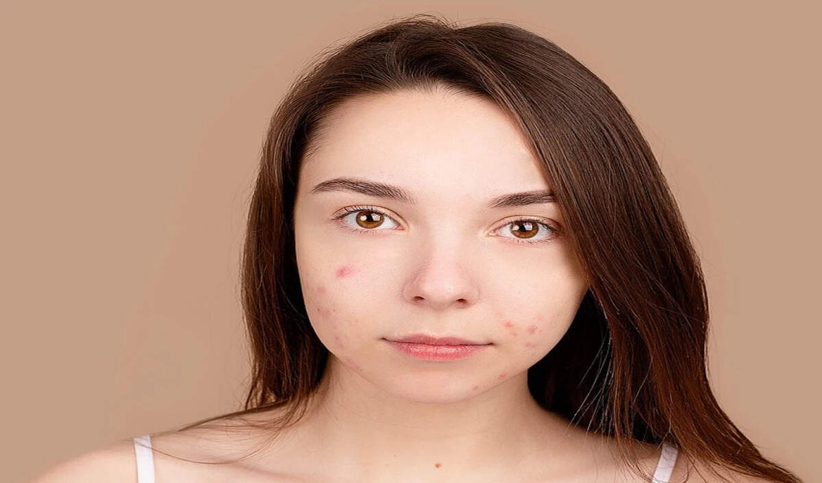 चेहरे पर पिंपल्स से छुटकारा पाने के लिए आसान उपाय